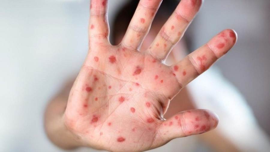 ظهور أول حالة إصابة بجدري القرود في مصر