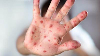 ظهور أول حالة إصابة بجدري القرود في مصر